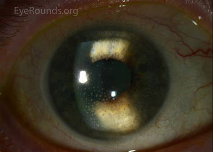 Atlas Entry MuttonFat Keratic Precipitates (KP)