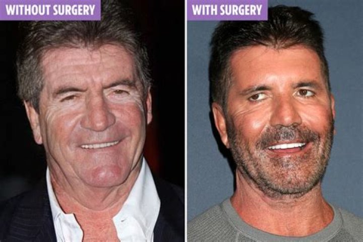 Has Simon Cowell Had Plastic Surgery on His Face? Bizrahmed