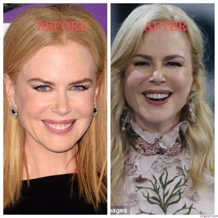 Nicole Kidman Gets a Facelift? Our Plastic Surgery Experts Weigh In