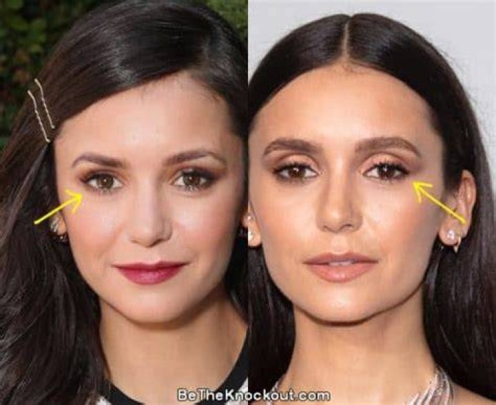 Nina Dobrev Plastic Surgery Comparison Photos
