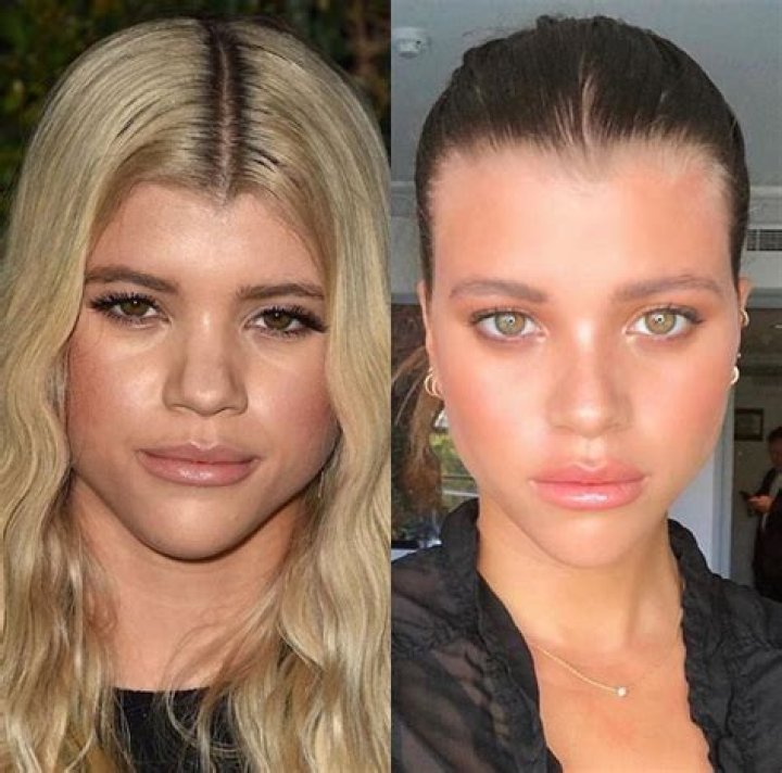 Sofia Richies Plastic Surgery Transformation: Before And After