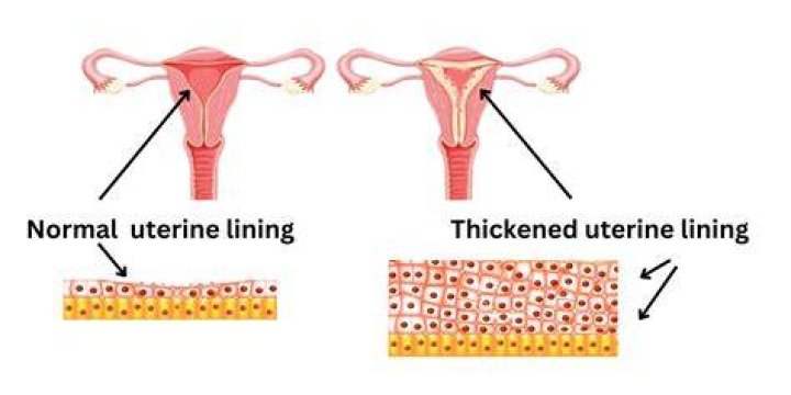 Thicken Uterine Lining 2 Powerful Treatments That Work