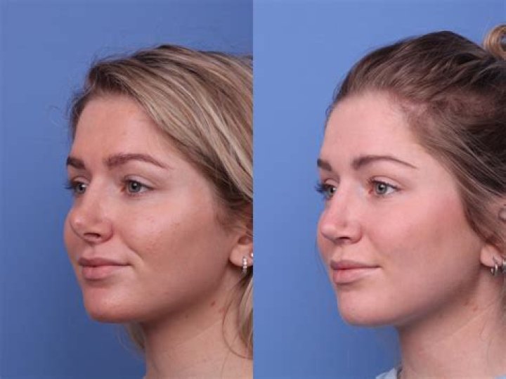Unveiling Corinna Kopf's Transformation: Plastic Surgery Before And After Insights