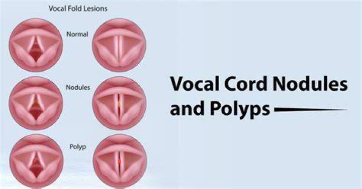 Vocal Nodules vs Polyps What's the Difference? Long Ridge Band