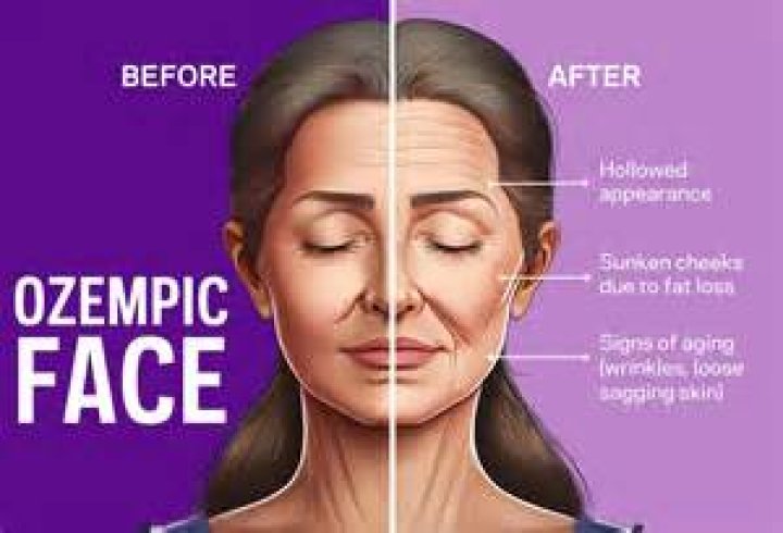 What Is Ozempic And Why Is It Gaining Attention? Explained